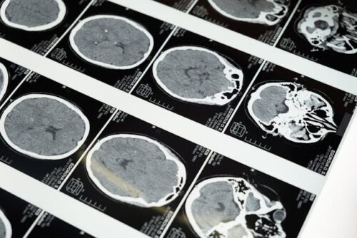 brain injuries