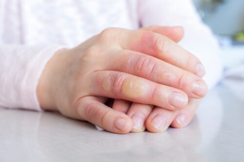 Hand with second degree burns on the fingers