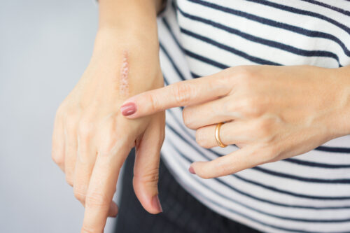 Close up of cooking oil burn scar on a woman's hands. The skin damage in first-degree on outer layer skin. Healing, Removal, Treatment, Accident in the kitchen, Scar, Scald, Wound Healing concept.